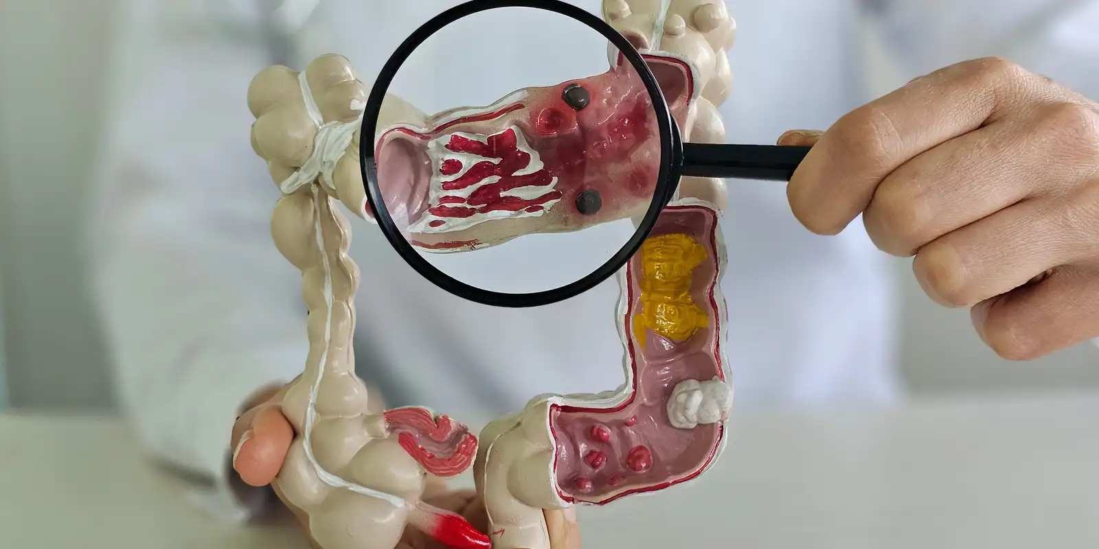 Casos de doenças inflamatórias intestinais crescem cinco vezes